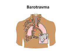 Akciğer barotravması, Akciğer barotravması nedir, Akciğer barotravması tehlikeleri, nefes tutmak